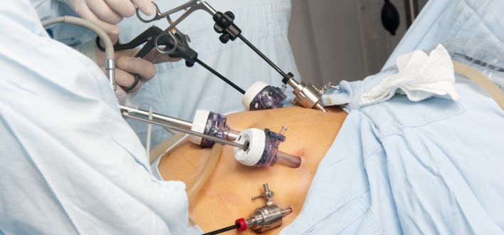 3D Laparoscopic Surgery
