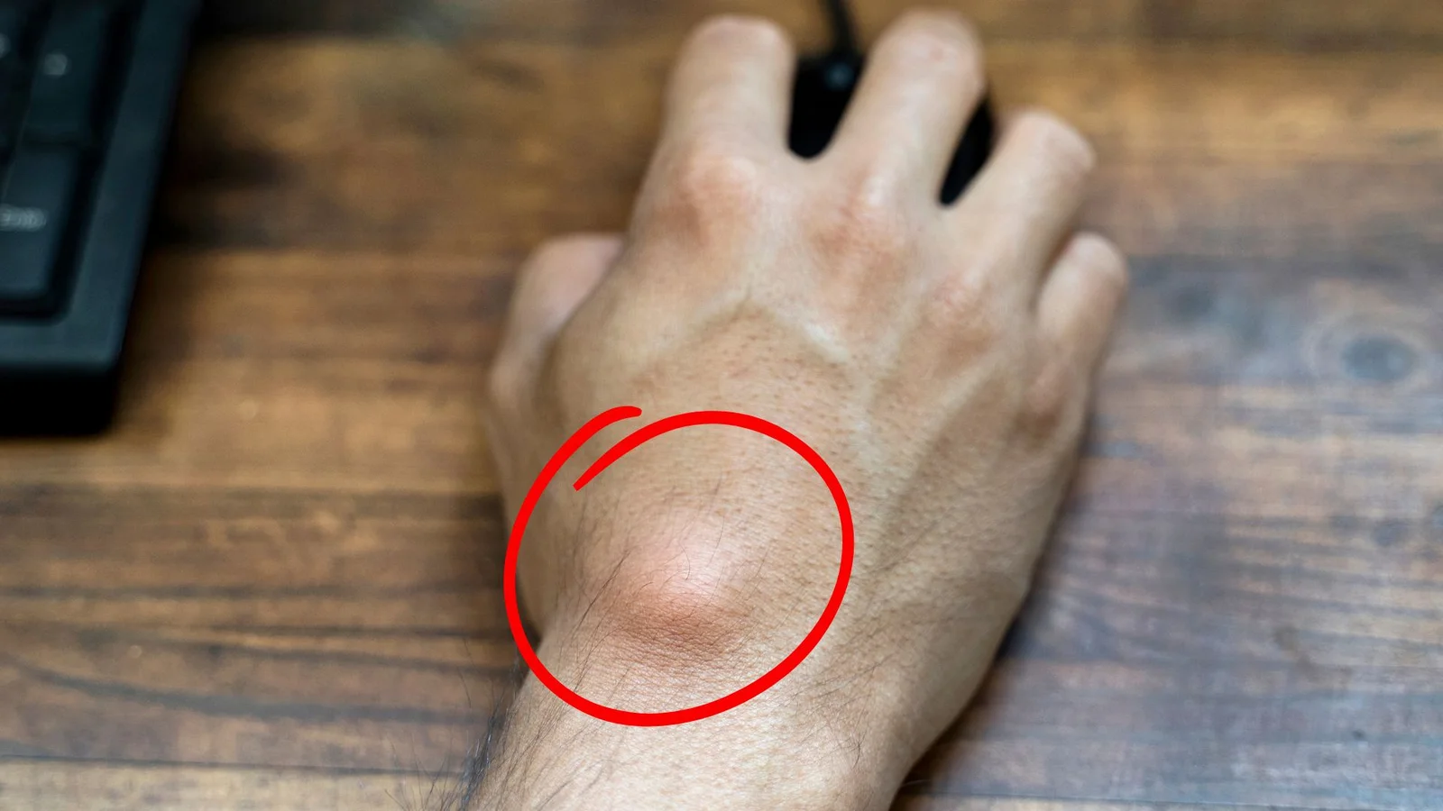 Lipoma: Symptoms, Causes & Treatment — A Comprehensive Guide